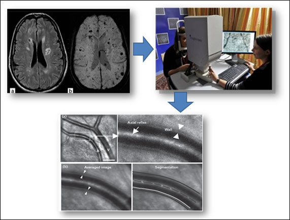 chabriat-neurologie