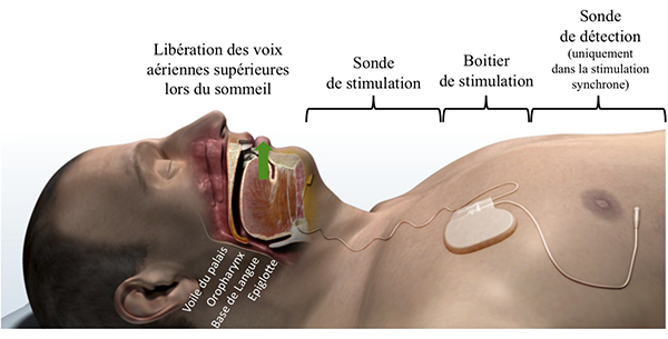 Source : chu-bordeaux.fr